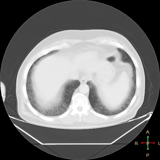 File:Centrilobular emphysema - with superimposed infection (Radiopaedia 24389-24683 lung window 24).jpg