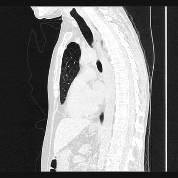 Centrilobular pulmonary emphysema (Radiopaedia 24495-24789 Sagittal lung window 44).jpg