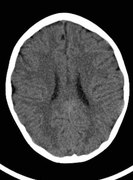 Cerebellar abscess (Radiopaedia 73727-84527 Axial non-contrast 45).jpg