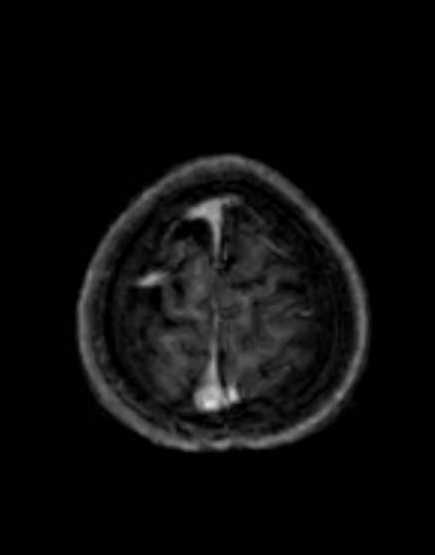 Cerebellar abscess (Radiopaedia 73727-84563 Axial T1 C+ fat sat 99).jpg