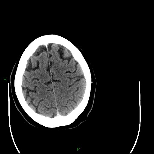 Cerebellar abscess (Radiopaedia 78135-90671 Axial C+ delayed 88).jpg