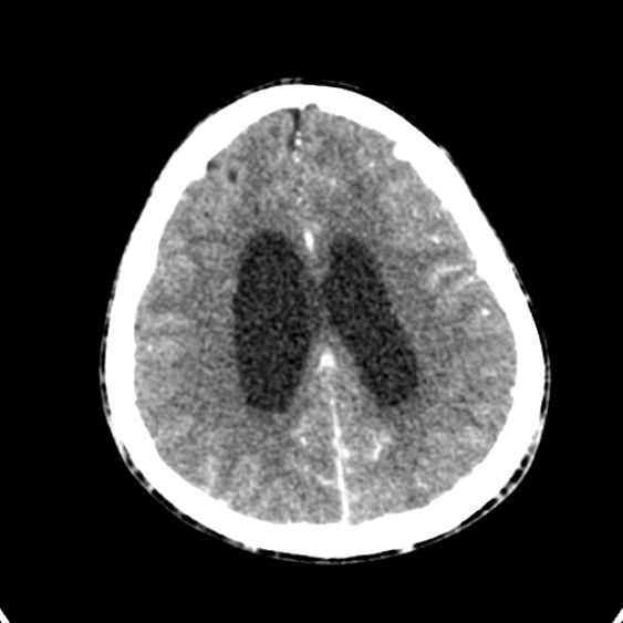 Cerebellar abscess secondary to mastoiditis (Radiopaedia 26284-26412 Axial C+ delayed 115).jpg