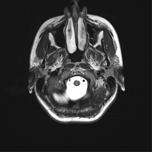 File:Cerebellar agenesis with hypoplastic pons (pontocerebellar hypoplasia) (Radiopaedia 57224-64138 Axial T2 5).png