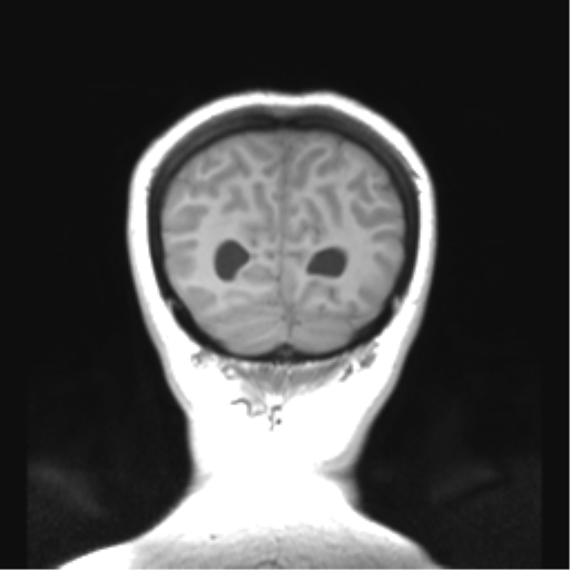 Cerebellar ependymoma complicated by post-operative subdural hematoma (Radiopaedia 83322-97736 Coronal T1 50).png