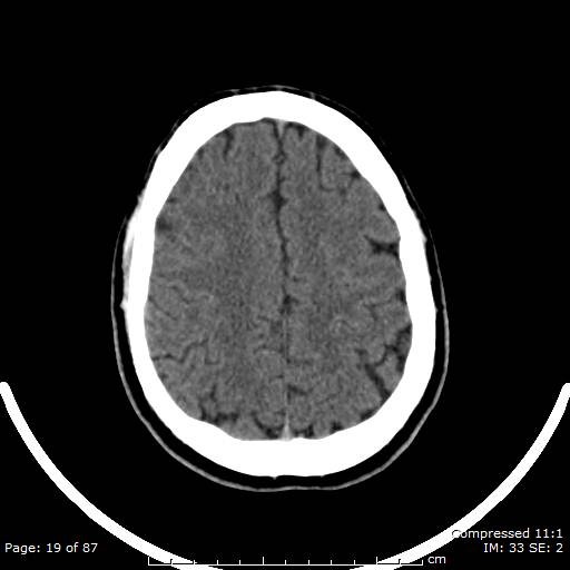 Cerebellar hemangioblastoma (Radiopaedia 52360-58258 Axial non-contrast 19).jpg