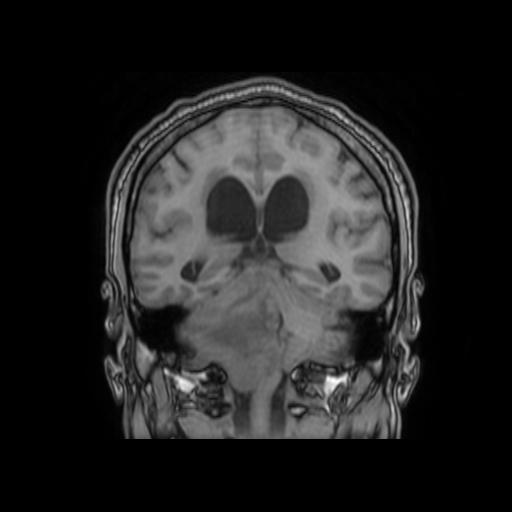 File:Cerebellar hemangioblastoma (Radiopaedia 88055-104622 Coronal T1 23).jpg