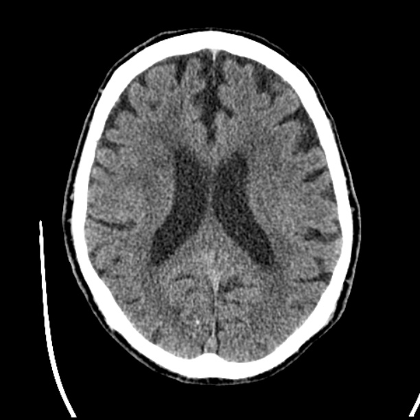 Cerebellar hemorrhage (Radiopaedia 27193-27359 Axial non-contrast 31).jpg