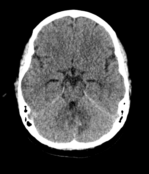 Cerebellar metastases - colorectal adenocarcinoma (Radiopaedia 40947-43652 Axial non-contrast 22).png