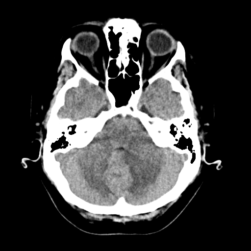 Cerebellar metastasis (Radiopaedia 54578-60812 Axial non-contrast 12).png