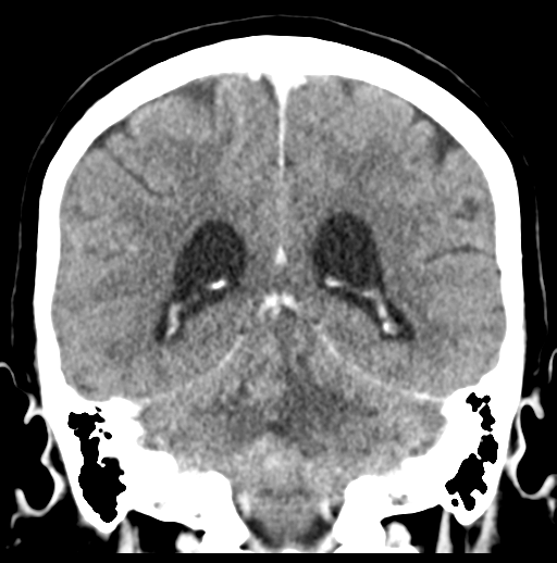 Cerebellar metastasis (Radiopaedia 54578-60812 Coronal C+ 39).png