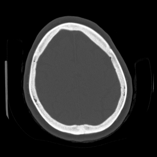 Cerebellar metastasis (cystic appearance) (Radiopaedia 41395-44258 Axial bone window 55).png