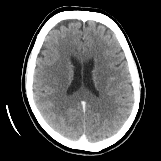 Cerebellar metastasis (cystic appearance) (Radiopaedia 41395-44258 B 31).png