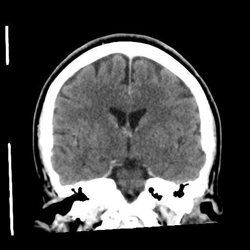 Cerebellar metastasis (cystic appearance) (Radiopaedia 41395-44258 D 32).png