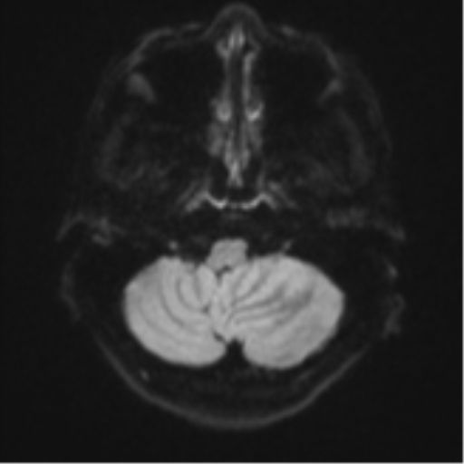 Cerebellar metastasis - adenocarcinoma lung (Radiopaedia 63184-71715 Axial DWI 33).png