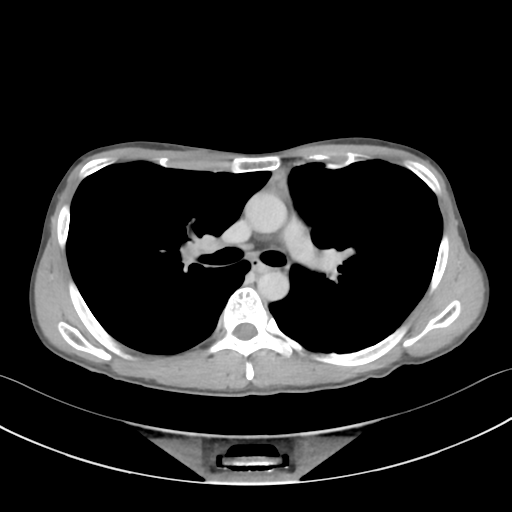 Cerebellar metastasis - adenocarcinoma lung (Radiopaedia 63184-71717 Axial C+ delayed 29).png