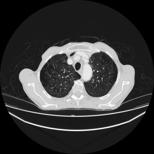 File:Cerebellar metastasis - lung tumor (Radiopaedia 69317-79150 Axial lung window 7).jpg