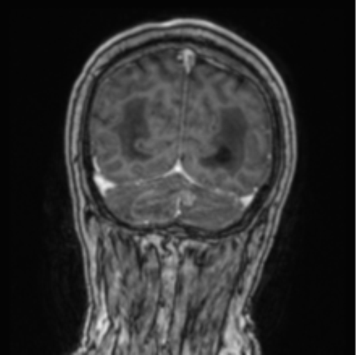 Cerebellar metastasis from lung adenocarcinoma (Radiopaedia 86690-102829 Coronal T1 C+ 21).png