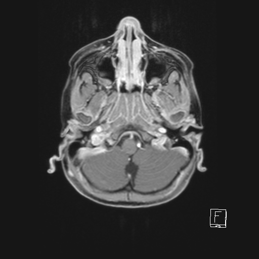 File:Cerebellar stroke (Radiopaedia 32202-33150 Axial T1 C+ 19).png