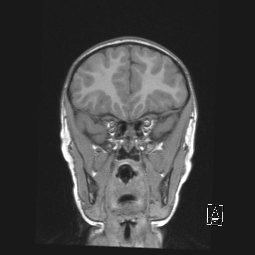 Cerebellar stroke (Radiopaedia 32202-33150 Coronal T1 16).png
