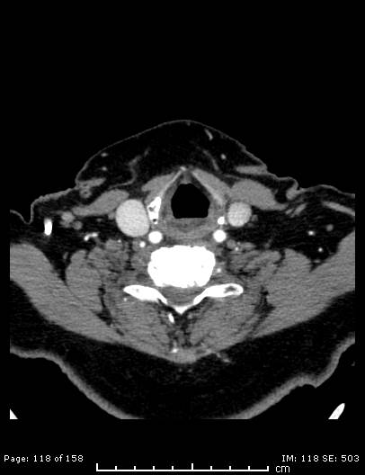 File:Cerebellar strokes due to intracranial giant cell arteritis (Radiopaedia 68799-78510 CT angiogram 118).jpg