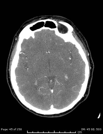 Cerebellar strokes due to intracranial giant cell arteritis (Radiopaedia 68799-78510 CT angiogram 45).jpg