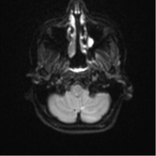 Cerebellar tuberculomas (Radiopaedia 46939-51472 Axial DWI 4).png