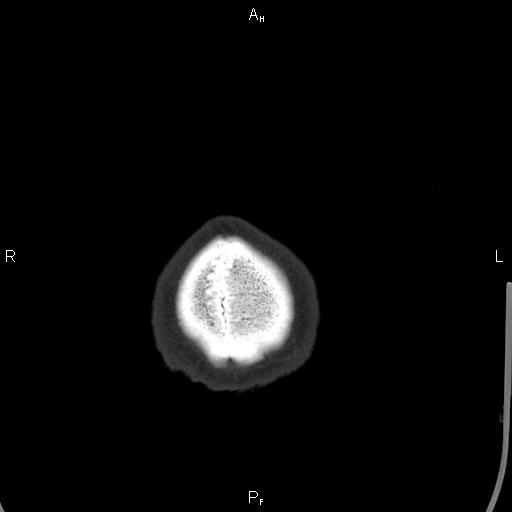 Cerebellopontine angle arachnoid cyst (Radiopaedia 85149-100704 Axial bone window 55).jpg