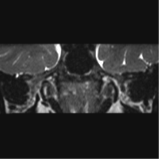 File:Cerebellopontine angle meningioma (Radiopaedia 48434-53348 Coronal T2 76).png