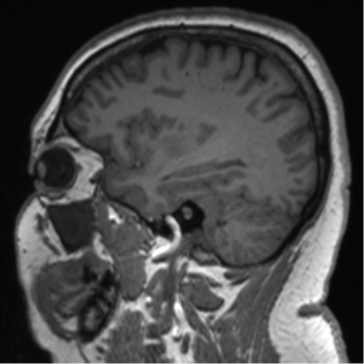 Cerebellopontine angle meningioma (Radiopaedia 48434-53348 Sagittal T1 30).png