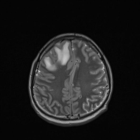 Cerebral abscess (Radiopaedia 24212-24478 Axial T2 45).jpg