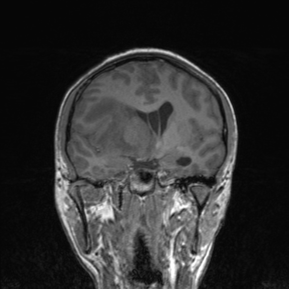 Cerebral abscess (Radiopaedia 24212-24478 Coronal T1 102).jpg