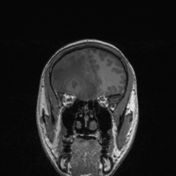 File:Cerebral abscess (Radiopaedia 24212-24478 Coronal T1 65).jpg