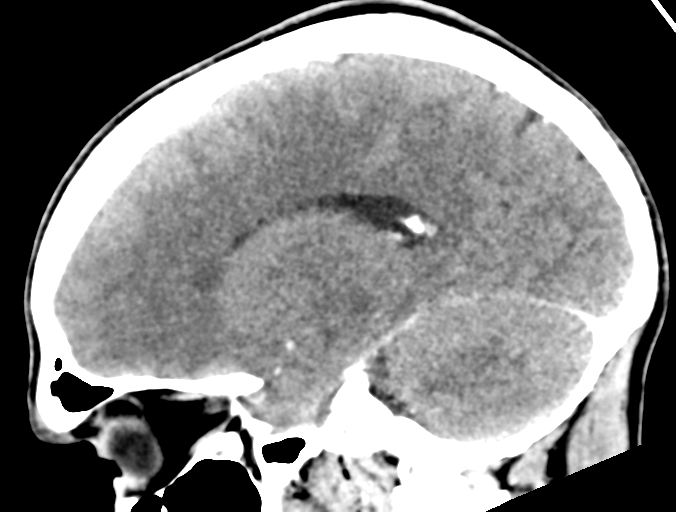 File:Cerebral abscess (Radiopaedia 60342-68008 Sagittal C+ delayed 20).png