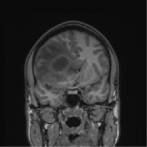 Cerebral abscess (Radiopaedia 60342-68009 Coronal T1 33).png