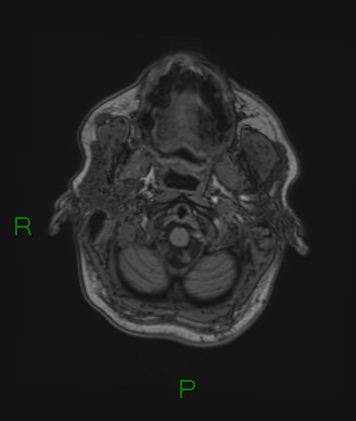 Cerebral abscess and subdural empyema (Radiopaedia 84436-99779 Axial T1 79).jpg
