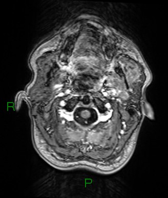 Cerebral abscess and subdural empyema (Radiopaedia 84436-99779 Axial T1 C+ 83).jpg