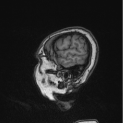 Cerebral abscess from pulmonary arteriovenous malformation (Radiopaedia 86275-102291 Sagittal T1 24).png