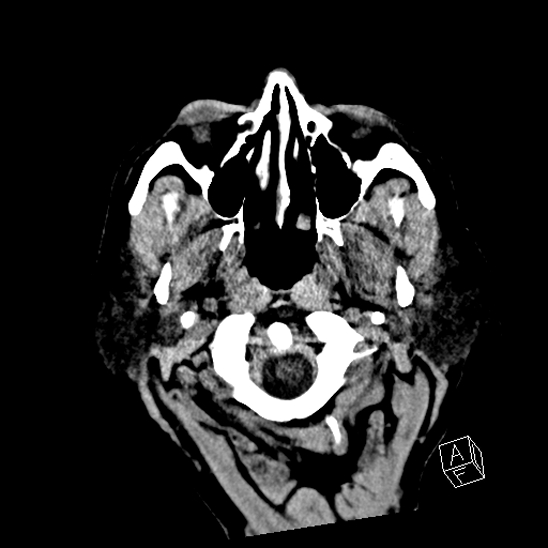Cerebral abscess with ventriculitis (Radiopaedia 78965-91876 Axial non-contrast 3).jpg