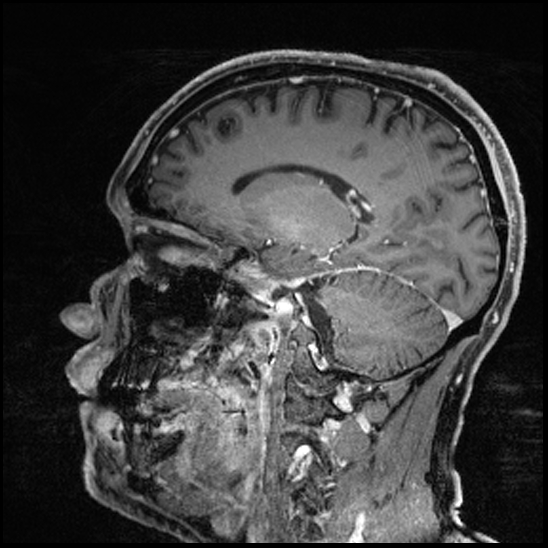 Cerebral abscess with ventriculitis (Radiopaedia 78965-91878 Sagittal T1 C+ 73).jpg