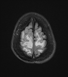 File:Cerebral amyloid angiopathy-related inflammation (Radiopaedia 74836-85849 Axial FLAIR 26).jpg