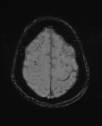 Cerebral amyloid angiopathy-related inflammation (Radiopaedia 74836-85849 Axial SWI 59).jpg