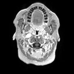 Cerebral amyloid angiopathy (Radiopaedia 29129-29518 Axial T1 C+ 7).jpg