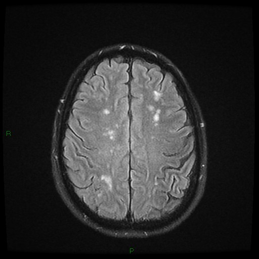 File:Cerebral amyloid angiopathy (Radiopaedia 77506-89664 Axial FLAIR 21).jpg