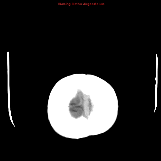 File:Cerebral and orbital tuberculomas (Radiopaedia 13308-13310 B 28).jpg