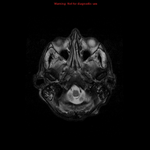 File:Cerebral and orbital tuberculomas (Radiopaedia 13308-13311 Axial T2 3).jpg