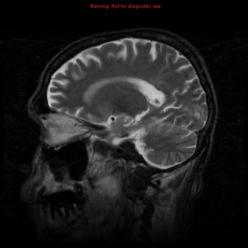File:Cerebral and orbital tuberculomas (Radiopaedia 13308-13311 Sagittal T2 7).jpg