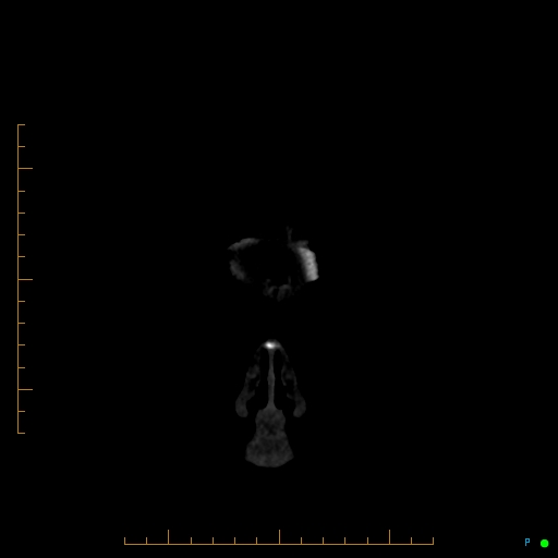 Cerebral arteriovenous malformation (AVM) (Radiopaedia 78162-90706 Coronal CTA 100).jpg