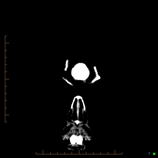 Cerebral arteriovenous malformation (AVM) (Radiopaedia 78162-90706 Coronal non-contrast 5).jpg