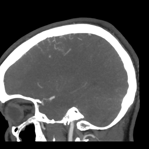 Cerebral arteriovenous malformation (Radiopaedia 39259-41505 Sagittal 20).png