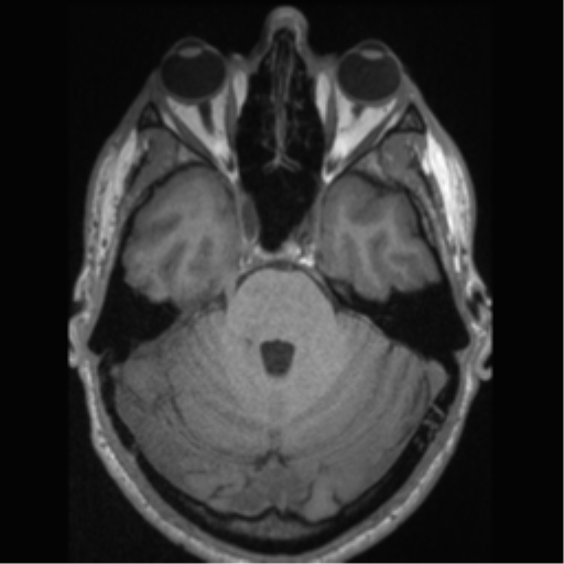 File:Cerebral arteriovenous malformation (Radiopaedia 55798-62372 Axial T1 17).png